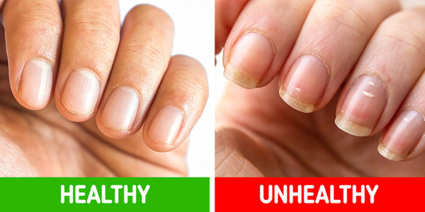 Chấm trắng trên móng tay. Những chấm trắng trên móng tay có thể xuất hiện sau chấn thương móng hoặc do thói quen cắn móng. Ngoài ra, đây cũng là dấu hiệu cơ thể thiếu dinh dưỡng như kẽm, canxi hoặc protein.