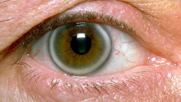 Thực tế, những “vòng tròn” này là sự tích tụ của chất béo. Lượng cholesterol cao càng khiến vòng tròn dễ xuất hiện. Hầu hết chúng ta sẽ đối diện arcus senilis khi về già. Tuy nhiên, nếu thấy chúng khi tuổi đời còn trẻ thì nên điều chỉnh thói quen ăn uống, sinh hoạt để cải thiện.