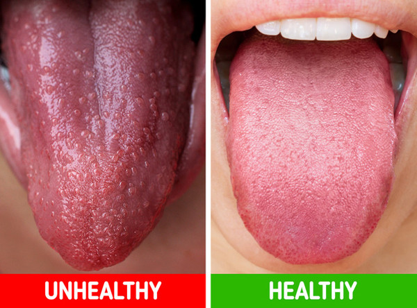 Lưỡi đỏ không chỉ là dấu hiệu của nhiễm trùng mà còn có thể bắt nguồn từ việc thiếu vitamin. Ban đỏ cũng là một trong những nguyên nhân khác dẫn đến tình trạng trên. Ban đỏ sẽ khiến lưỡi trở nên nhợt nhạt nhưng vẫn có những chấm đỏ tươi.