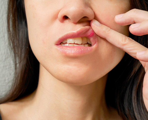 Nhiệt, loét miệng. Nhiệt miệng, loét miệng là tình trạng sức khỏe phổ biến song thường ít được sự quan tâm. Thực tế, nhiệt miệng chủ yếu bắt nguồn từ thay đổi nội tiết tố hoặc căng thẳng kéo dài.