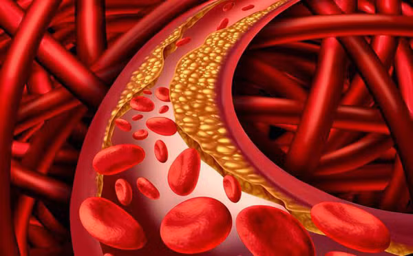 Đi khám, anh rất bất ngờ khi bác sĩ chẩn đoán anh bị mỡ máu cao. Siêu âm Doppler màu ổ bụng cũng cho thấy bệnh nhân bị gan nhiễm mỡ mức độ trung bình. Nhận kết quả, Trương rất hoang mang vì hàng ngày anh chủ yếu ăn đồ chay. Không hiểu vì lý do gì mà mỡ máu lại cao như vậy.