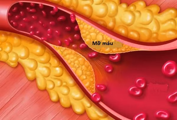 Được biết, bệnh mỡ máu (hay còn được gọi là bệnh máu nhiễm mỡ, rối loạn chuyển hóa lipid máu) là tình trạng chỉ số thành phần mỡ có trong máu vượt quá mức giới hạn do các nguyên nhân dẫn đến rối loạn chức năng chuyển hóa mỡ trong máu.