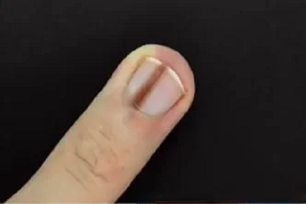 Dấu hiệu trên móng tay cảnh báo ung thư, khám ngay còn kịp Dau hieu tren mong tay canh bao ung thu, kham ngay con kip