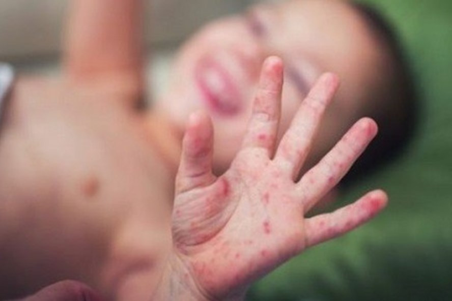 Chủng virus gây đại dịch tay chân miệng năm 2011 đã trở lại? Chung virus gay dai dich tay chan mieng nam 2011 da tro lai?