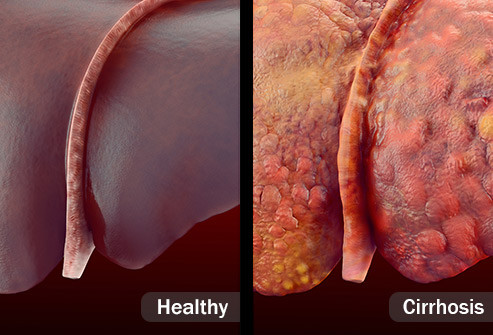  Bệnh gan nhiễm mỡ không do rượu Bệnh này thường là vô hại. Nhưng ở một số người phát triển tình trạng nghiêm trọng hơn dẫn đến gan bị sưng, có thể dẫn đến xơ gan (sẹo trên gan không lành), nguy cơ ung thư gan và bệnh tim cao hơn.