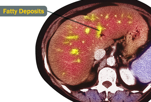 Khi có quá nhiều chất béo tích tụ trong gan sẽ gây ra bệnh gan nhiễm mỡ. Có hai loại cơ bản: bệnh gan nhiễm mỡ không do rượu (NAFLD) và bệnh gan nhiễm mỡ có cồn. Chất béo dư thừa có thể gây ra những thay đổi ngăn gan hoạt động tốt. Và vì gan giúp lọc chất độc ra khỏi máu, khi chức năng gan hoạt động kém có thể khiến bạn bị bệnh.