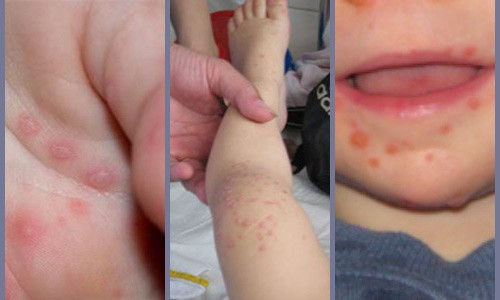 Virus tay chan mieng tung khien 164 nguoi tu vong nguy hiem the nao?