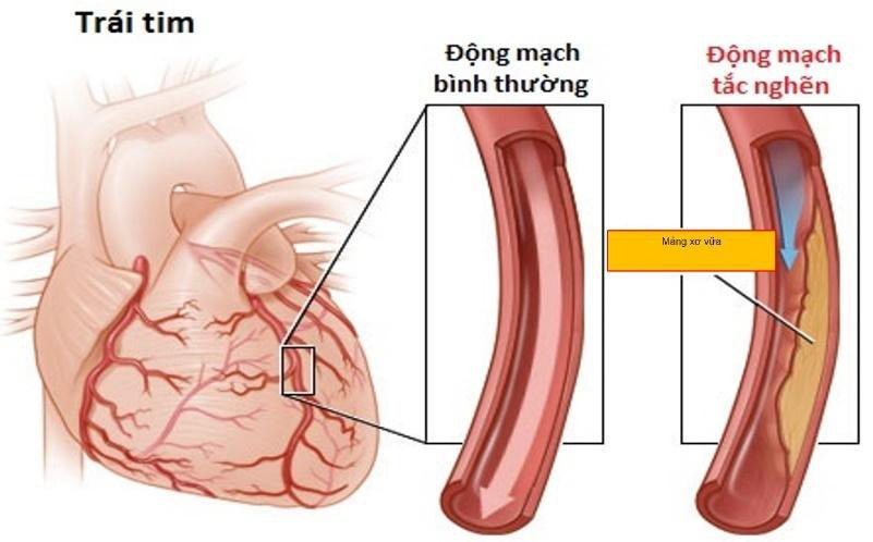 Chu tich UBND TP Yen Bai dot tu: Bi nhoi mau co tim xu ly the nao?