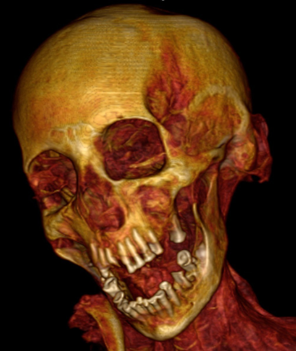 Người phụ nữ này bị xơ vữa động mạch vành trái và phải, động mạch cổ, động mạch chủ bụng, động mạch chậu gốc và chi dưới.