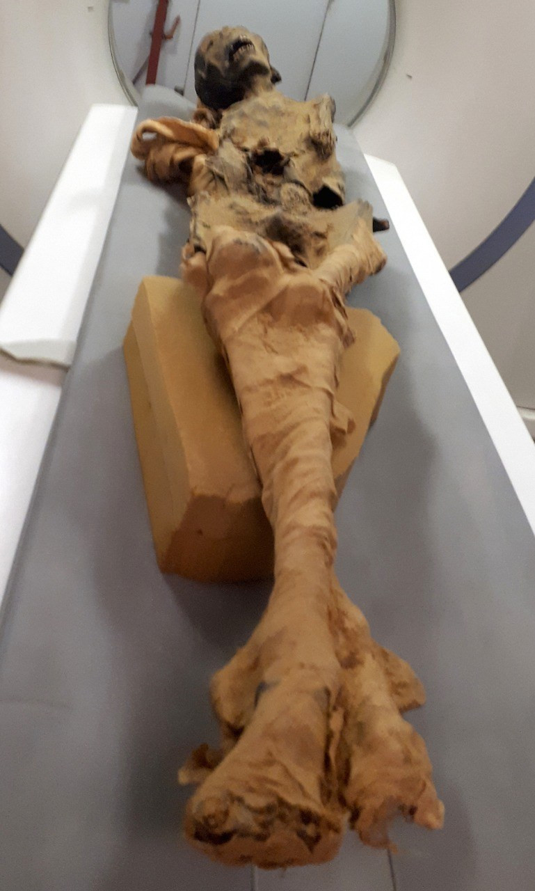 Căn bệnh nguy hiểm này đã làm hẹp lòng mạch và tắc nghẽn mạch máu dẫn đến cái chết đầy đau đớn của "người phụ nữ la hét". Vài giờ sau khi "người phụ nữ la hét" tử vong, người ta mới phát hiện sự việc.