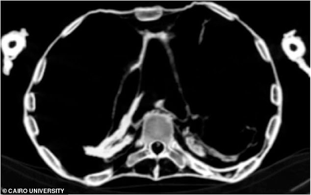 Sau nhiều năm nghiên cứu, các chuyên gia tìm ra câu trả lời. Theo nhà Ai Cập học Zahi Hawass và giáo sư X-quang học Sahar Saleem tại Đại học Cairo, "người phụ nữ la hét" qua đời đột ngột vì đau tim.