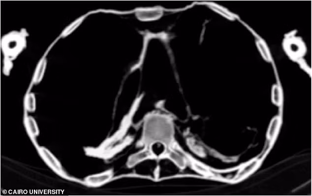 Sau nhiều năm nghiên cứu, các chuyên gia tìm ra câu trả lời. Theo nhà Ai Cập học Zahi Hawass và giáo sư X-quang học Sahar Saleem tại Đại học Cairo, "người phụ nữ la hét" qua đời đột ngột vì đau tim.