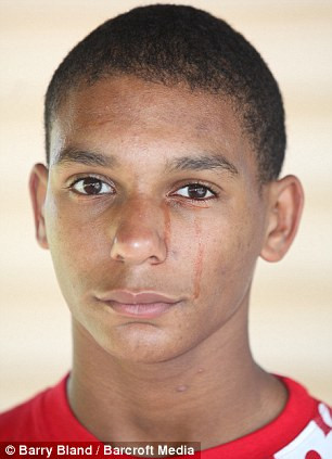 Bác sĩ người Italy Antonio Brassavola sống ở thế kỷ 16 gây chú ý với báo cáo về trường hợp của một nữ tu bật khóc với những giọt nước mắt có màu đỏ như máu.