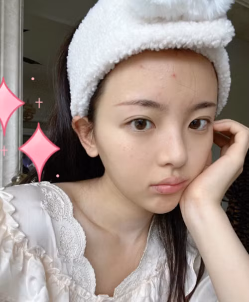 Dương Siêu Việt tuy xinh đẹp nhưng làn da chưa được chăm chút kỹ càng, lộ mụn sưng đỏ.