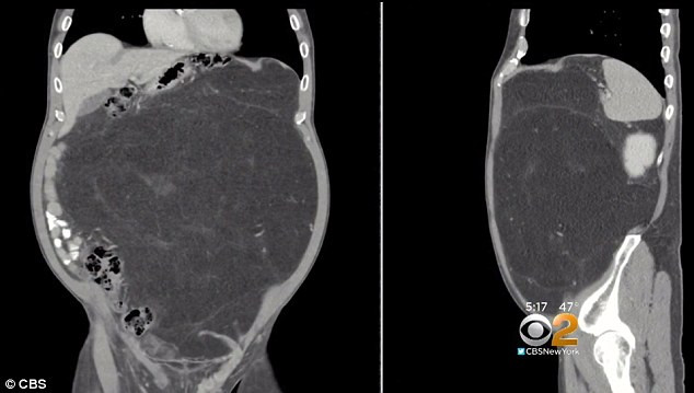 Tuong “bung bia”, ta hoa phat hien vat nay trong co the suot 10 nam-Hinh-2