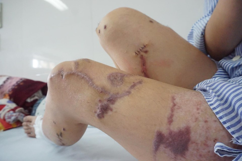 Dung nhan co gai bi cuu thieu uy cong an tat axit huy hoai the nao?-Hinh-9