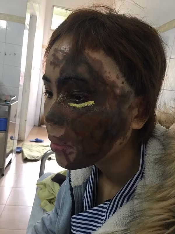 Dung nhan co gai bi cuu thieu uy cong an tat axit huy hoai the nao?-Hinh-2