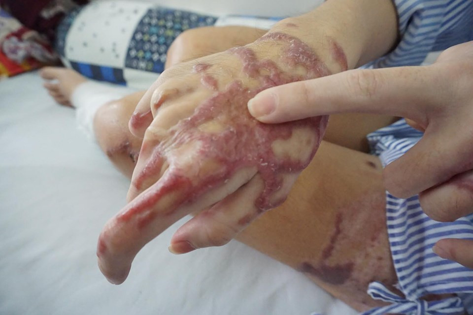 Những vết thương còn chi chít trên thân thể Vy, hằng ngày cào xé, đau đớn.