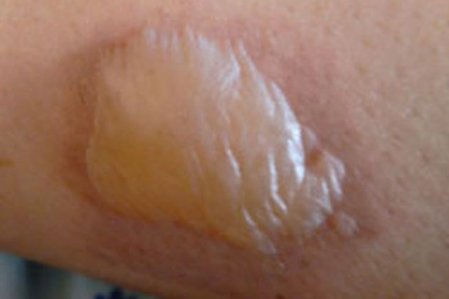 Tuy nhiên, do trộm cây cung bạc nên Ambrogio bị nữ thần săn bắn Artemis nguyền rủa rằng sẽ bị bỏng nếu chạm phải bạc.