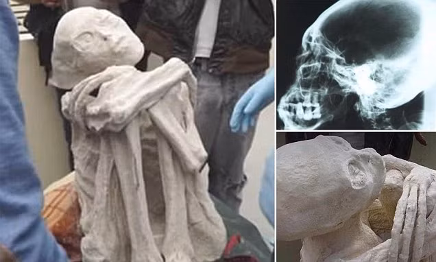 Do cấu trúc xương sườn khác với người bình thường nên các chuyên gia hết sức cẩn thận khi thực hiện kiểm tra các cơ quan nội tạng của Maria.