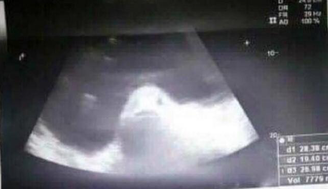 Thieu nu co bung to bat thuong khien dan lang nghi mang thai voi ca-Hinh-2