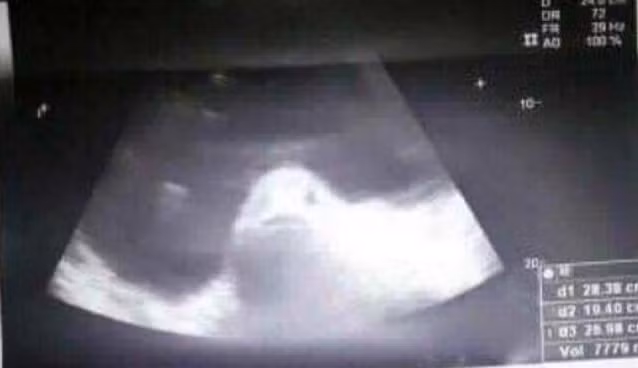 Thieu nu co bung to bat thuong khien dan lang nghi mang thai voi ca-Hinh-2