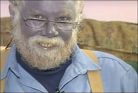 Theo các chuyên gia, trung bình mỗi ngày, khoảng 3% lượng Hemoglobin tự ôxy hóa thành Methb. Nhưng nồng độ Methb trong máu chỉ dưới 1%.