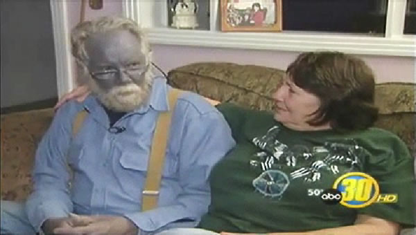 Vào năm 1958, một thành viên trong gia tộc Fugate đến bệnh viện khám sức khỏe thì các bác sĩ không khỏi bất ngờ khi nhìn thấy một người có làn da màu xanh.