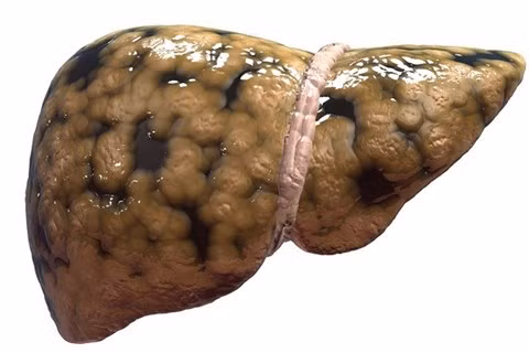 Tre nho 4-5 tuoi da bi mo dong “trang gan” vi mon an ua thich