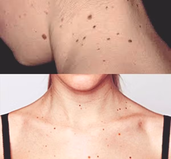 Xem vị trí, hình dạng nốt ruồi phát hiện ung thư da nguy hiểm Xem vi tri, hinh dang not ruoi phat hien ung thu da nguy hiem