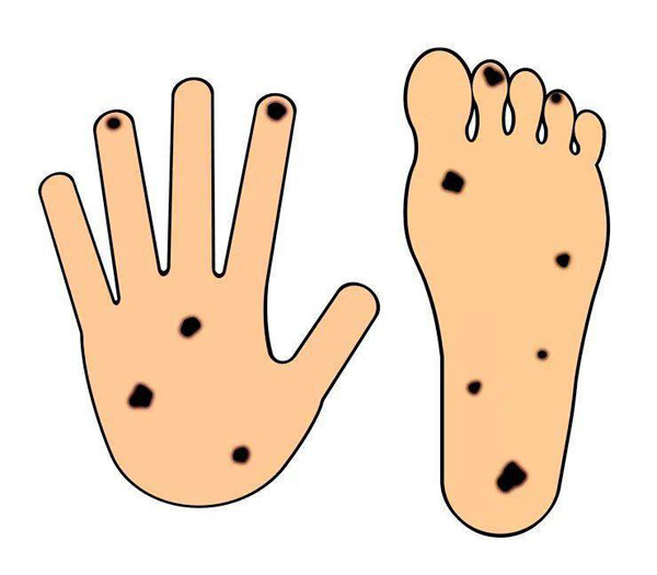 Quan sát kỹ vùng da dưới móng tay, ngón chân góp phần phát hiện sớm mầm mống căn bệnh.