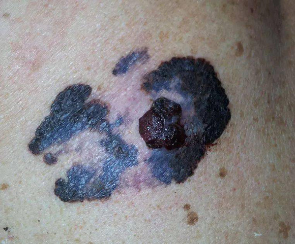 Thay đổi theo thời gian (Evolution). Nốt ruồi bình thường sẽ không thay đổi kích thước theo thời gian. Nó cũng không gây khó chịu cho khổ chủ. Nếu thấy nốt ruồi có xu hướng lớn dần, viêm nhiễm ở các vùng da lân cận, gây ngứa, khó lành... thì có khả năng nó đang chuyển thành ác tính.