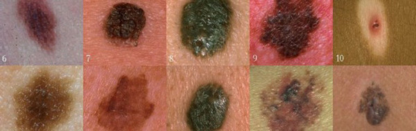 Ngoài vị trí, nhìn vào hình dạng nốt ruồi cũng chỉ ra dấu hiệu ung thư đến gần. Khi quan sát, bạn áp dụng nguyên tắc ABCDE sẽ nhận diện nốt ruồi có bất thường hay không.