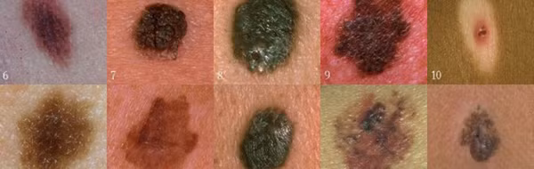 Ngoài vị trí, nhìn vào hình dạng nốt ruồi cũng chỉ ra dấu hiệu ung thư đến gần. Khi quan sát, bạn áp dụng nguyên tắc ABCDE sẽ nhận diện nốt ruồi có bất thường hay không.