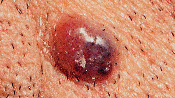 Đặc biệt, những người có tiền sử u hắc tố, gia đình có người mắc bệnh thì hết sức cẩn thận. Nên tự kiểm tra da mỗi tháng kết hợp nhờ bác sĩ chuyên môn đánh giá. Những người nguy cơ cao nên duy trì tần suất khám 4 lần mỗi năm. Ảnh: Internet.