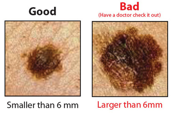 Đường kính (Diameter). Nốt ruồi thông thường sẽ có kích thước nhỏ hơn 6mm. Trong khi đó, nốt ruồi ác tính sẽ lớn hơn 6mm. Dù vậy, không thể hoàn toàn dựa vào đường kính nốt ruồi mà kết luận ngay được. Bạn vẫn cần sinh thiết để có được kết quả chắc chắn.