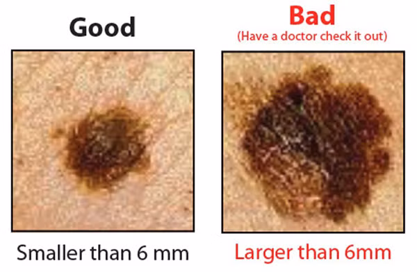 Đường kính (Diameter). Nốt ruồi thông thường sẽ có kích thước nhỏ hơn 6mm. Trong khi đó, nốt ruồi ác tính sẽ lớn hơn 6mm. Dù vậy, không thể hoàn toàn dựa vào đường kính nốt ruồi mà kết luận ngay được. Bạn vẫn cần sinh thiết để có được kết quả chắc chắn.