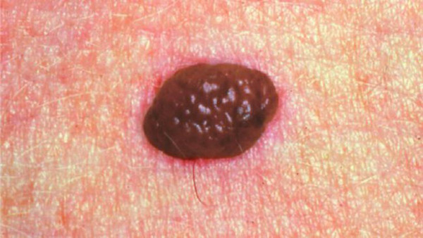 Dấu hiệu phát hiện ung thư da ABCDE giúp bạn phát hiện bất thường trên da song không vì thế mà bỏ qua những buổi kiểm tra sức khỏe thường niên. Rất nhiều trường hợp sống khỏe nhờ phát hiện bệnh kịp thời.