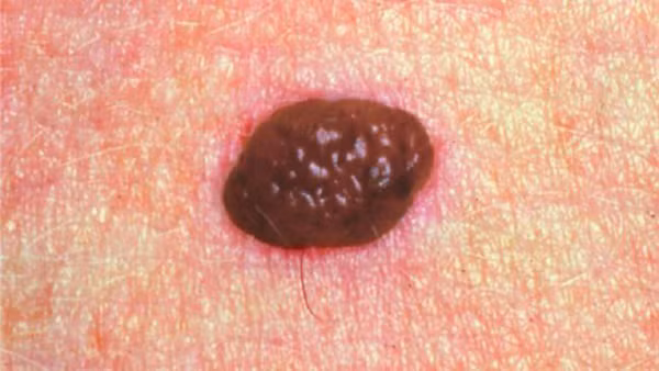 Dấu hiệu phát hiện ung thư da ABCDE giúp bạn phát hiện bất thường trên da song không vì thế mà bỏ qua những buổi kiểm tra sức khỏe thường niên. Rất nhiều trường hợp sống khỏe nhờ phát hiện bệnh kịp thời.