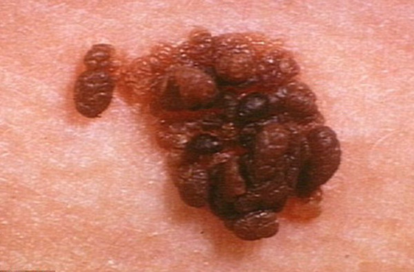 Không đối xứng (Asymme). Hầu hết nốt ruồi trên cơ thể có dạng hình tròn, đối xứng. Nếu một bên nốt ruồi của bạn không tròn hoặc méo thì bạn nên xem lại. Hãy tưởng tượng, khi cắt đôi nốt này ra, nó phải là hình ảnh phản chiếu của nhau thì đó mới là một nốt ruồi bình thường.