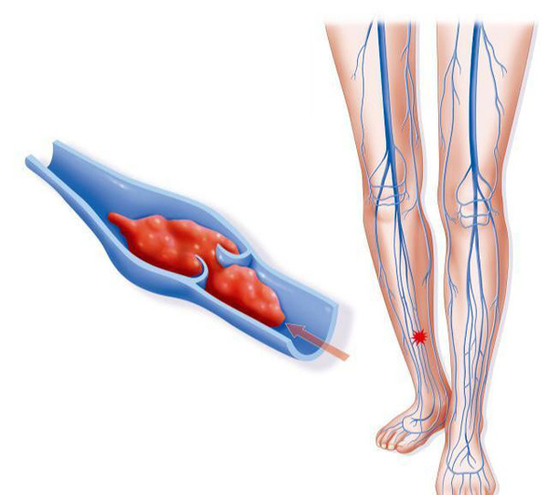 Yếu toàn bộ chân, bàn chân. Hiện tượng tê yếu chi dưới có thể xuất phát từ vấn đề mạch máu tắc nghẽn. Tình trạng này thường gặp ở bệnh nhân huyết khối, tê một bên người, khó gắng sức gây trở ngại trong quá trình đi lại, làm việc.