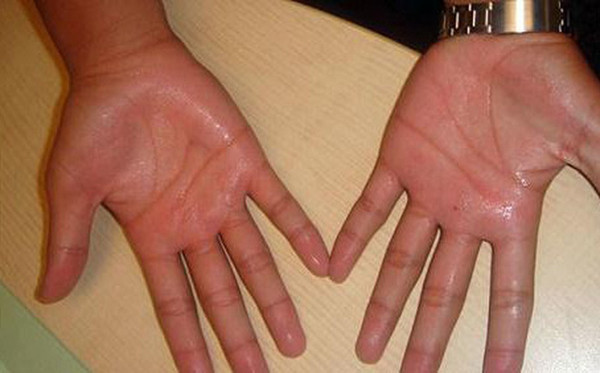  Tay chân. So với các bộ p hận khác, tay và chân không dễ đổ mồ hôi. Tuy nhiên, khi tâm trạng lo lắng, căng thẳng, xúc động hay sợ hãi, lòng bàn tay và bàn chân sẽ tiết ra mồ hôi.