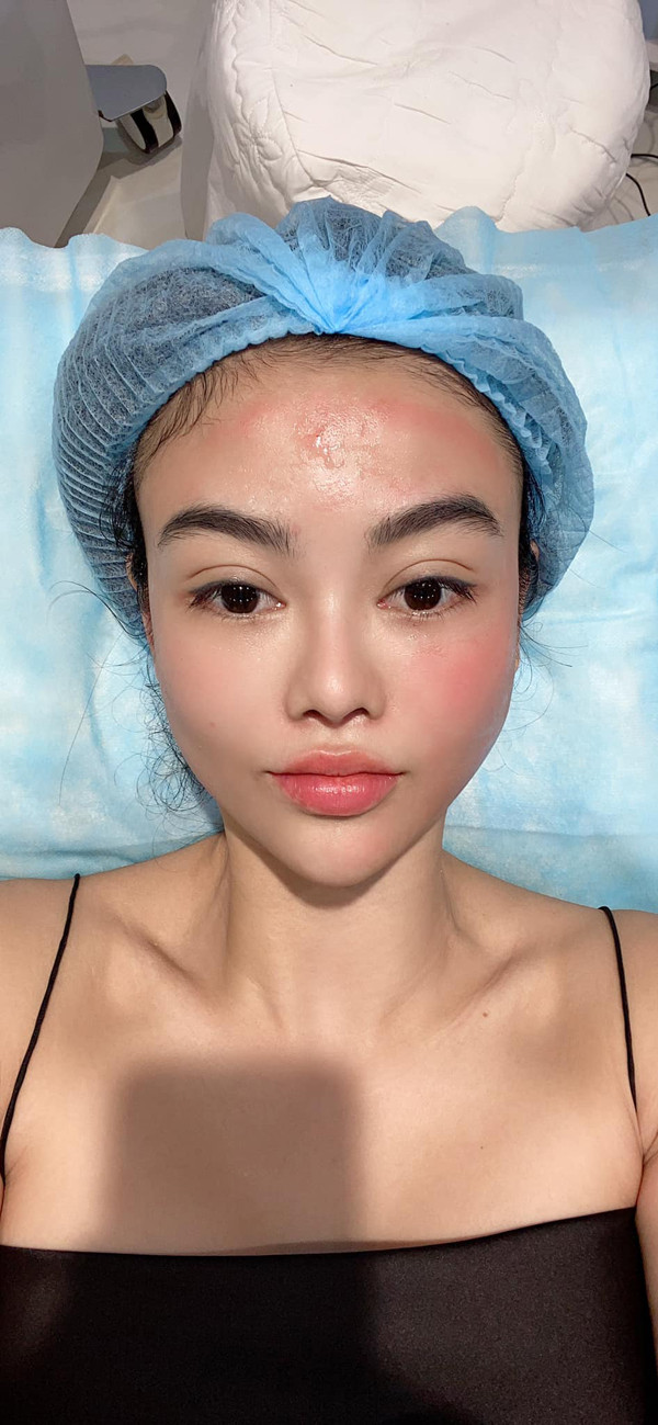 Người thực hiện sẽ dùng thứ này tiêm lại vào mặt khách hàng, giúp khôi phục và trẻ hóa các tế bào tổn thương, kích thích sản sinh tế bào mới. Ưu điểm của chích máu tự thân là các nhân tố tăng trưởng có trong tiểu cầu sẽ kích thích tế bào da mới tăng trưởng liên tục nên hiệu quả điều trị trẻ hóa da tăng cao và kéo dài.