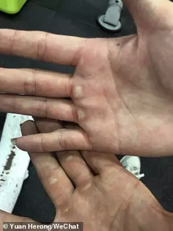 Cường độ luyện tập mạnh khiến cô ngày càng mạnh mẽ. Cùng với đó, những vết sần cũng xuất hiện ngày càng nhiều trên tay cô.