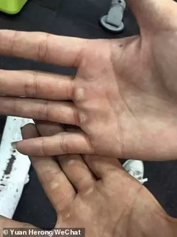 Cường độ luyện tập mạnh khiến cô ngày càng mạnh mẽ. Cùng với đó, những vết sần cũng xuất hiện ngày càng nhiều trên tay cô.