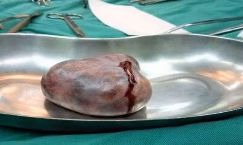 Cuu song nu sinh 18 tuoi mac benh viem nao hiem gap