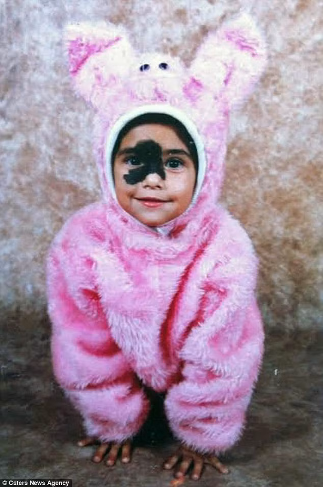 Năm 1998, khi chỉ còn là một đứa trẻ Mariana cha mẹ cô vì lo sợ con mình sẽ bị bắt nạt hoặc kỳ thị vì "đặc điểm đặc biệt" này cho nên đã quyết định đưa cô đi phẫu thuật laser nhưng điều tri này đã không mang lại hiệu quả như mong muốn.