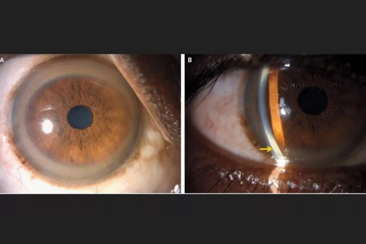 Di kham, nguoi dan ong tai mat thay 