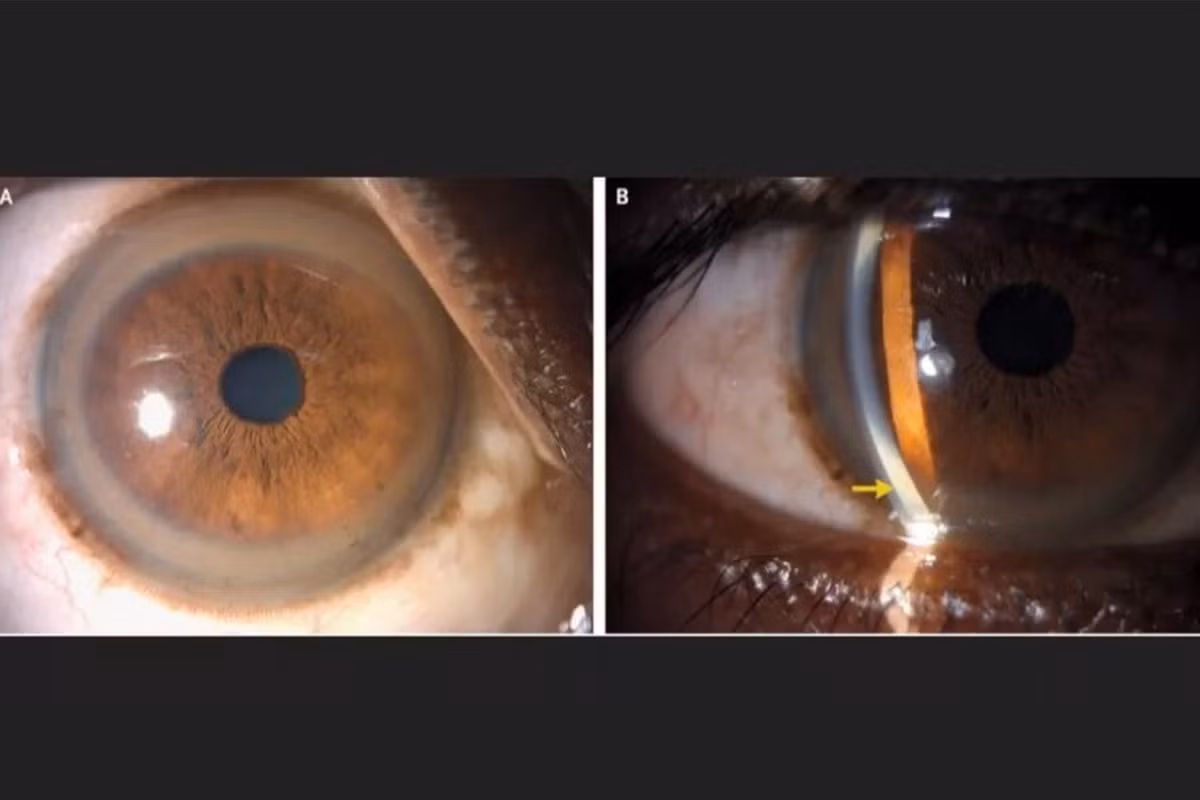 Di kham, nguoi dan ong tai mat thay 