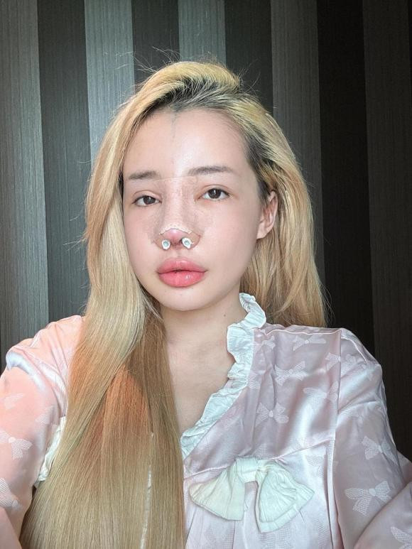 Trong lần sửa mũi thứ 12, bác sĩ thay thế sụn mũi bị viêm cho DJ Ngân 98 và giữ lại dáng mũi cho cô. Ảnh: FB DJ NGÂN 98